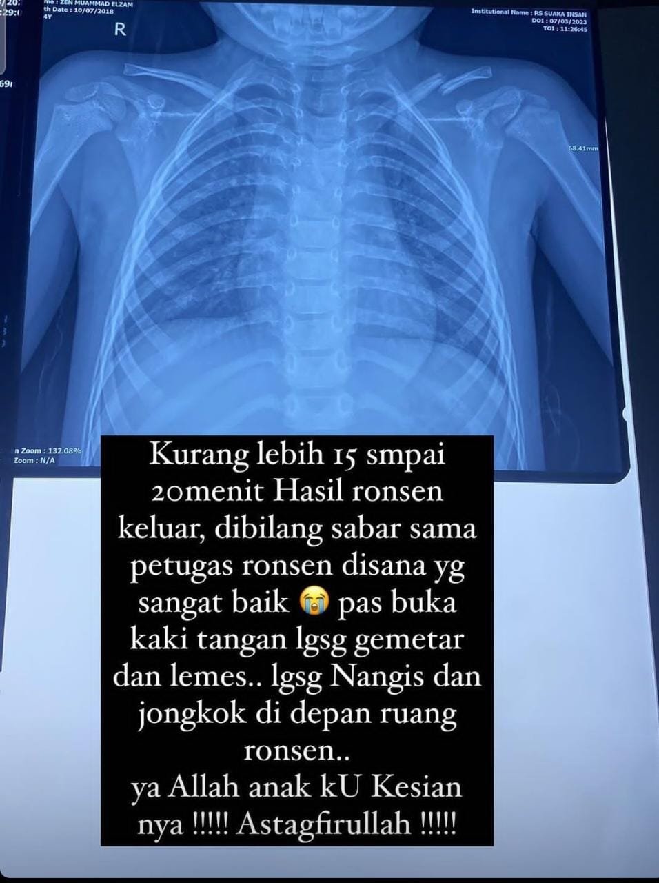 Diduga Dianiaya Oknum Guru, Siswa TK PAUD Alami Sendi Bahu Tergeser dan Tulang Selangka Bahu Patah 1 IMG 20230529 WA0016