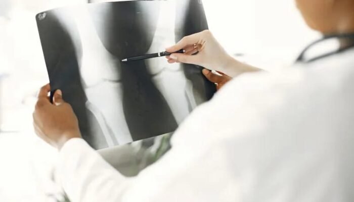 Perlu Pencegahan Osteoporosis Sejak Dini