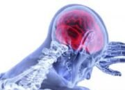 Gaya Hidup Hingga Riwayat Genetik Jadi Faktor Risiko Stroke