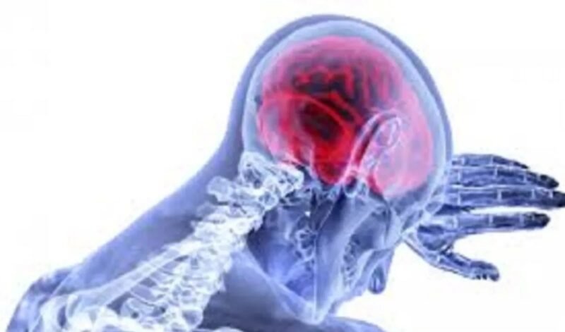 Gaya Hidup Hingga Riwayat Genetik Jadi Faktor Risiko Stroke 1 IMG 20260620 WA0029 e1781931231532